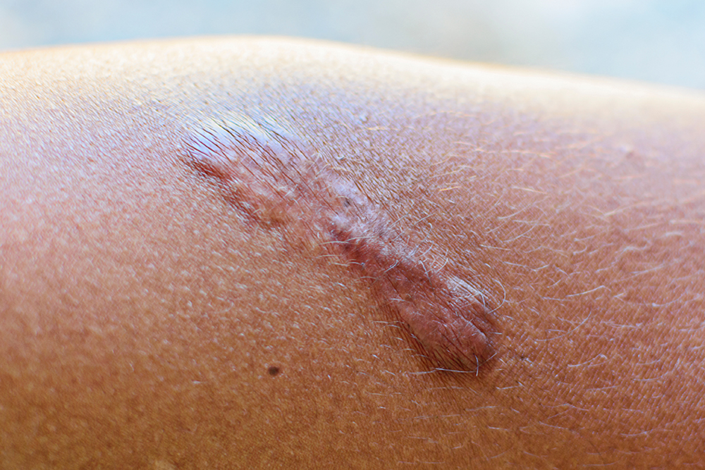 Narbenbehandlung in Herne